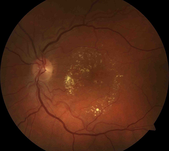 drusen-nach-der-behandlung-makuladegeneration
