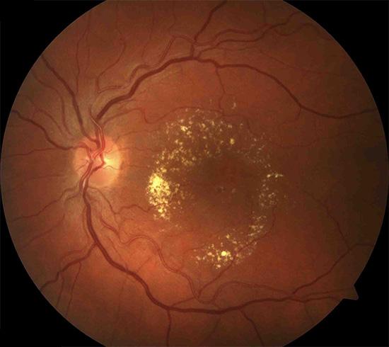 drusen-vor-der-behandlung-makuladegeneration
