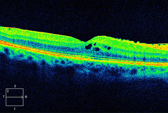 oct-drusen-bei-feuchter-amd-nach-der-behandlung