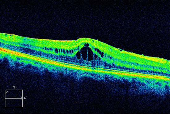 oct-drusen-bei-feuchter-amd-vor-der-behandlung
