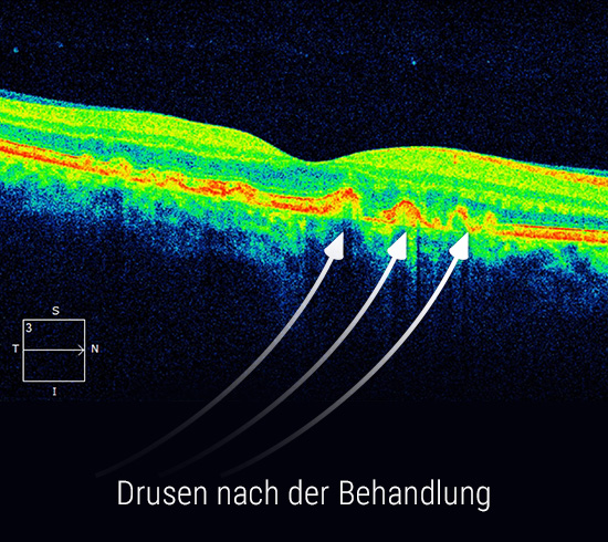 oct-drusen-bei-trockener-amd-nach-der-behandlung