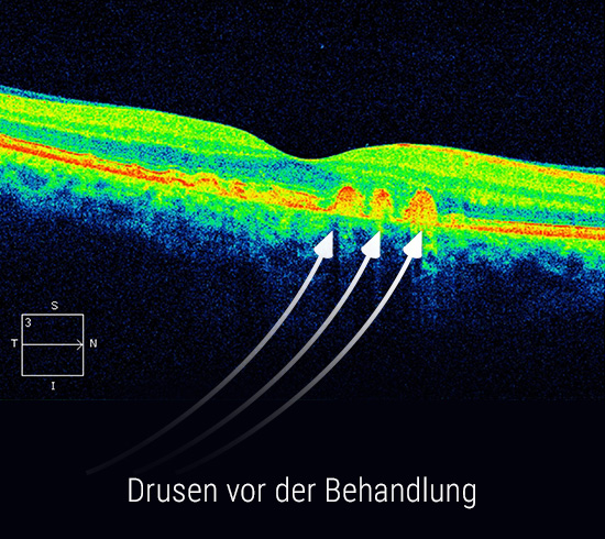 oct-drusen-bei-trockener-amd-vor-der-behandlung